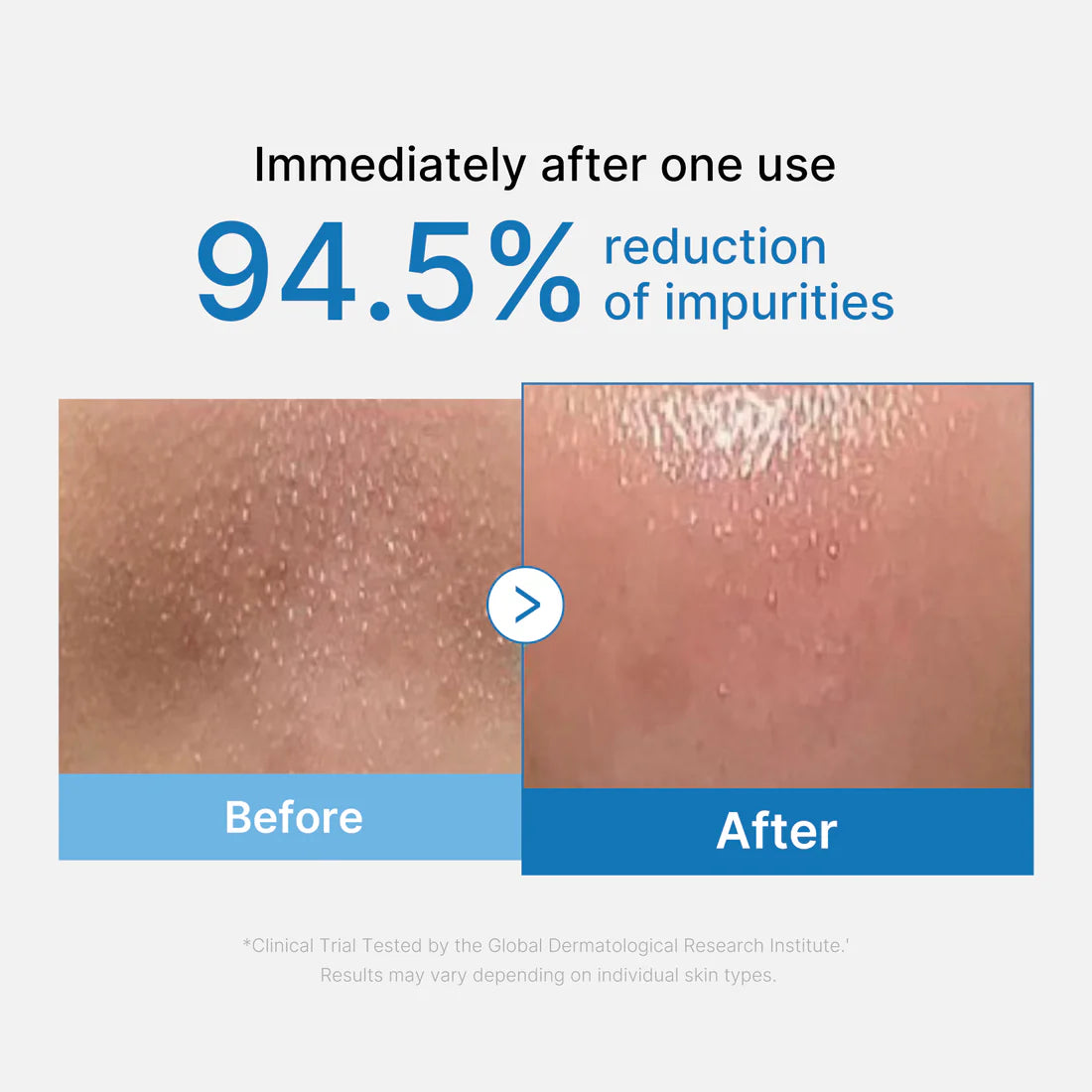 Medicube+ Zero Pore Blackhead Cleansing Oil - 94.5% reduction of impurities before after